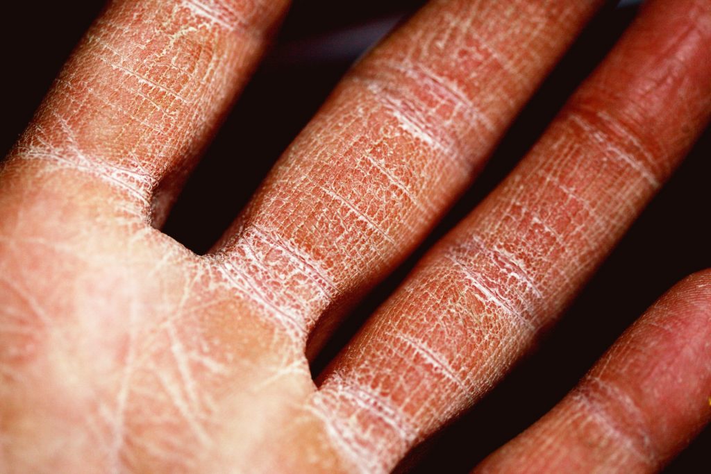 Summer eczema flare-ups - How to avoid them? Summer health tips for women with eczema